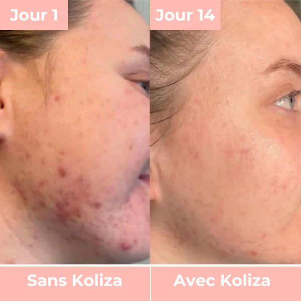 GlowMask™️ | Revolutionaire LED Lichttherapie